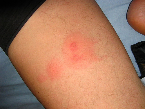 bed bug bites raised red bumps like welt these bites are very often ...