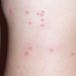 flea bites on toddler - BabyGaga